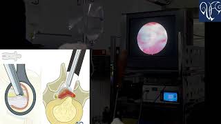 endoscopic discectomy  endoscopic spine surgery ILED Intralaminar lumbar endoscopic discectomy [upl. by Haisa357]