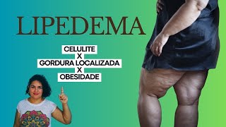 Como diferenciar Lipedema de gordura localizada celulite e obesidade sintomas [upl. by Comethuauc]