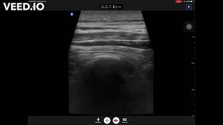 Bilateral erector spinae plane ESP block at T4 level for thoracic fusion surgery [upl. by Zalea813]