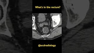 What’s in the rectum [upl. by Nielson]