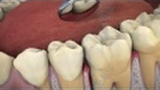 The Role of ARESTIN® in Periodontal Treatment [upl. by Cirtemed958]