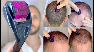 Como Usar o DermaRoller com Minoxidil Aloxidil Tratamento de Calvice Hereditária Queda de Cabelo 4K [upl. by Alanson979]