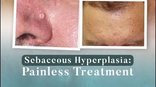 Sebaceous Hyperplasia Painless Treatment [upl. by Jara138]