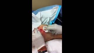 MRSA abscesses extraction [upl. by Azer]