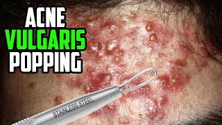 Acne Acne Vulgaris in Adults Condition Treatments and Pictures [upl. by Reppiks]