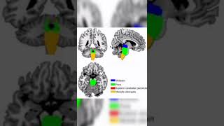 The Stroke  Brain stem stroke [upl. by Thordia]