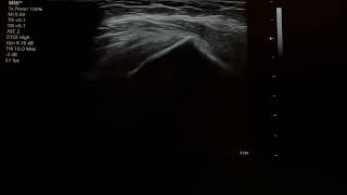 subacromial bursitis injection 24110101 [upl. by Melak]