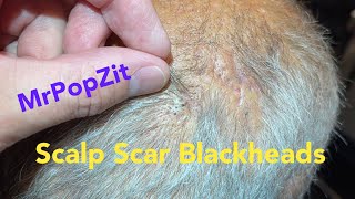 Scalp scar blackhead extractions Scar tissue on scalp filling with keratin extracted MrPopZit [upl. by Flodur]