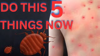 Bed Bugs How To Get Rid Of Them  Pest Control  Bed Bugs  Magic Ingredient [upl. by Notloc]