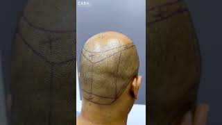 Cara Clinics REAL Hair Transplant Results That Will SHOCK You [upl. by Nnaecarg]