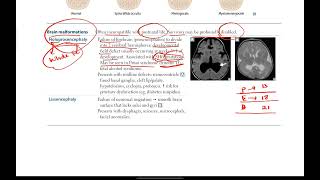 Neural tube defects Brain malformations  Neurology  2  First Aid USMLE Step 1 [upl. by Esenwahs]