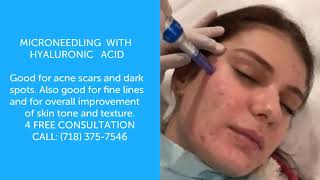 Microneedling with Hyaluronic Acid [upl. by Daenis]