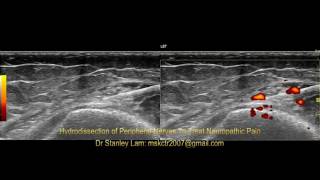 Ultrasound Guided Hydrodissection of Obturator Nerve and Saphenous Nerve at the Adductor Tubercle [upl. by Sutsuj]