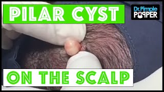 A Perfect Pilar Cyst Pop Dr Pimple Popper amp Buzzfeed [upl. by Aratnahs747]