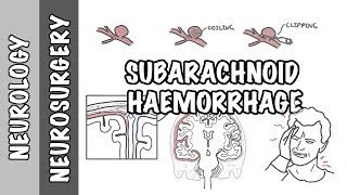 Subarachnoid Haemorrhage  pathophysiology complications and management [upl. by Ardnosal435]