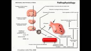 Takotsubo Cardiomyopathy I am Seeing it Everywhere [upl. by Hilly]