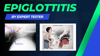 Epiglottitis  Causes  Symptoms  Diagnosis  Treatment amp Pathology [upl. by Bambie]