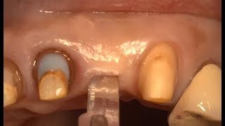 Minimally invasive implantation using NR Line [upl. by Barber]