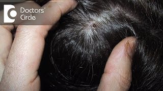 How can one manage scabs on scalp with itching white flakes amp dryness  Dr Rashmi Ravindra [upl. by Rudelson]