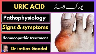 uric acid treatment in homeopathy Dr imtiaz Gondal [upl. by Atteuqcaj]