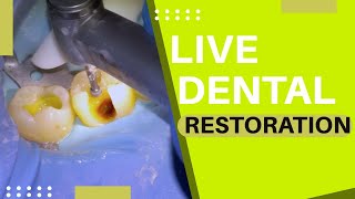 100 Live Dental Fillings  46OB 47O [upl. by Nnaacissej872]