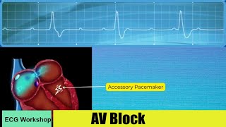 AV Block ECG features and Comparison with ECG simulator [upl. by Oiretule48]