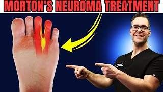 Numbness or Tingling in the Feet or Toes Mortons Neuroma Treatment [upl. by Eciram]