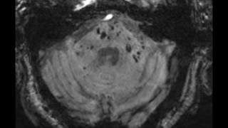 Multiple Cavernoma Syndrome [upl. by Pruchno]