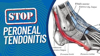 ResearchBacked Treatments for Peroneal Tendonitis Pain on the Outside of Your Foot When Running [upl. by Stanfield618]