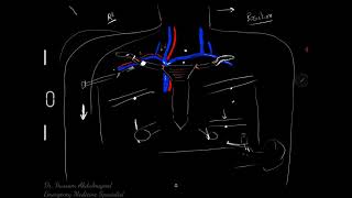 Subclavian Catheterization  InfraClavicular Approach [upl. by Cirek]