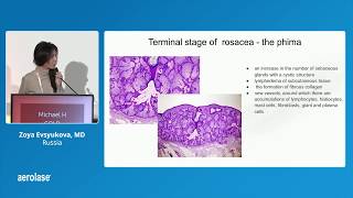 IMCAS 2020 Presentation on Rosacea by Zoya Evsyukova MD [upl. by Notsuj]