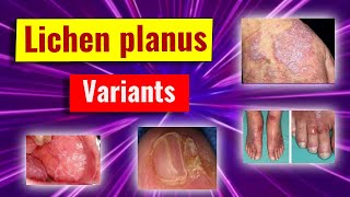 Clinical variants of lichen planus [upl. by Ratib]