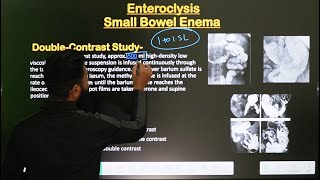 Small Bowel Enema  Enteroclysis Procedure  Part2  In Hindi  Radiological Procedure [upl. by Alger]