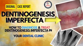 DENTINOGENESIS IMPERFECTA AN ORIGINAL CASE REPORT dentist youtubegrowth youtubegrow dentistry [upl. by Shuma]