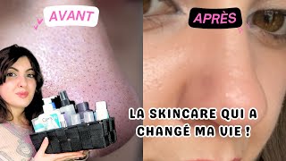 Comment se débarrasser de lacné des points noirs et des filaments sébacés  ma routine skincare [upl. by Forcier]