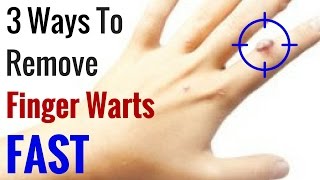 How to Get Rid of Warts on Fingers Fast  3 Natural Wart Remedies [upl. by Nicolle]