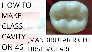 Class 1 Cavity Preparation On 46  Mandibular Right First Molar  LR6 [upl. by Huggins]