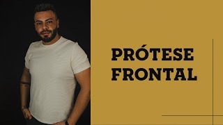 PRÓTESE FRONTAL [upl. by Malley]