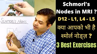 What are Schmorls Nodes Herniated Disc 3 Exercises for Lower Back Pain Relief Disc Degeneration [upl. by Goldenberg769]