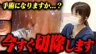 「放置すると癌になります」胃・大腸カメラの同日検査で発覚したポリープの進行度とは！？ [upl. by Ericka]