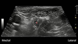 Femoral Nerve and Fascia Iliaca Blocks [upl. by Ontina]