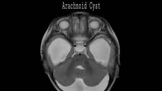 Arachnoid Cyst  st Demo [upl. by Eloccin]