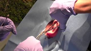 Live Earlobe Repair Demonstration with Dr Timothy Jochen [upl. by Airliah]