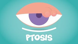 What is Ptosis [upl. by Colbert876]