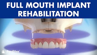 Full mouth rehabilitation with 6 dental implants and fixed denture © [upl. by Noreen375]