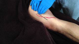 Dry Needling Adductor Magnus [upl. by Ybbed]