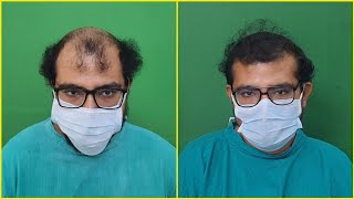 15 Months Hair Transplant Result amp 2nd Stage Marking amp Planning  FUE Result  Dr Jayanta Bain [upl. by Eanahc520]