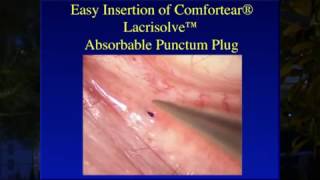 Inserting the Comfortear® Lacrisolve® 180 Absorbable Punctum Plug [upl. by Hiller]