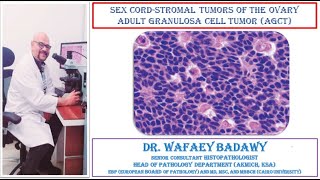 SEX CORD STROMAL TUMORS OF THE OVARY ADULT GRANULOSA CELL TUMOR BY DR WAFAEY BADAWY [upl. by Hgieleak168]