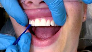 Tips For Applying Fluoride Varnish [upl. by Rozalin604]